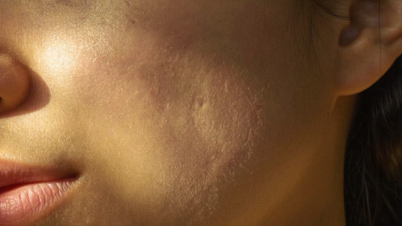 Acne scar types: why one cheek canneed four different answers