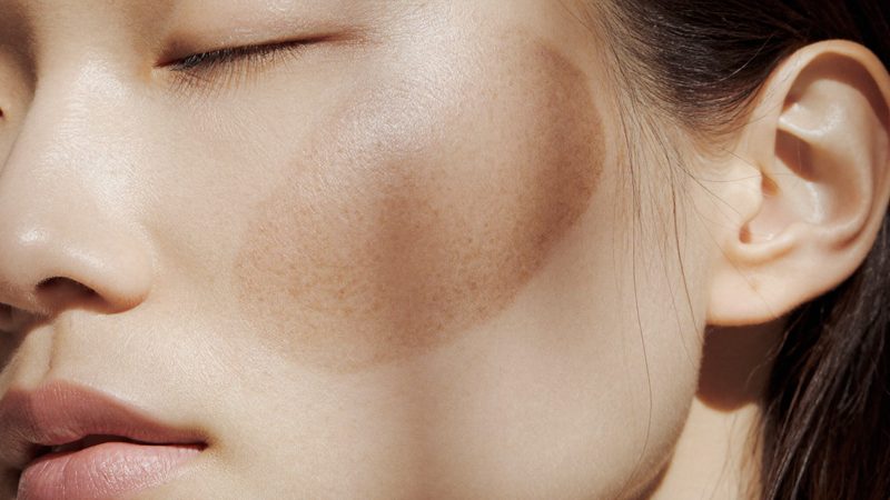 Melasma or sun spots?Two look-alikes, treated almost oppositely