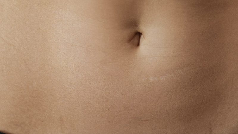 Surgical scars: when you treat onematters as much as how
