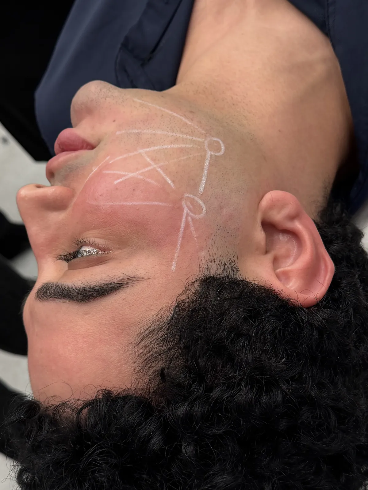 Pre-treatment vector and zone mapping marked on the face before Secret Duo treatment