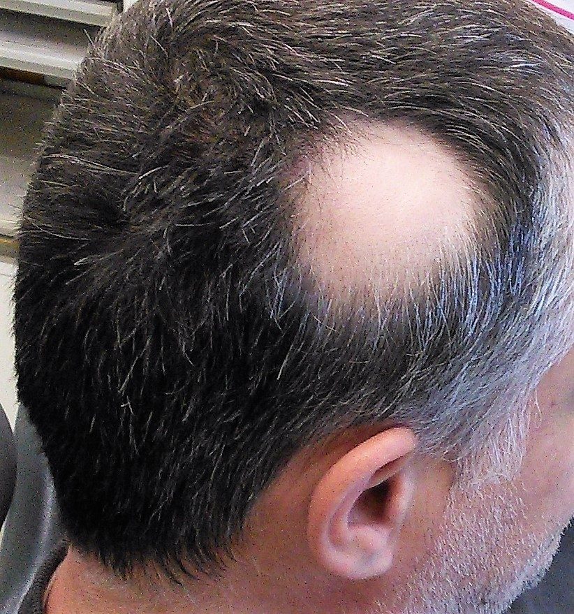 A discrete round patch over the occipital scalp