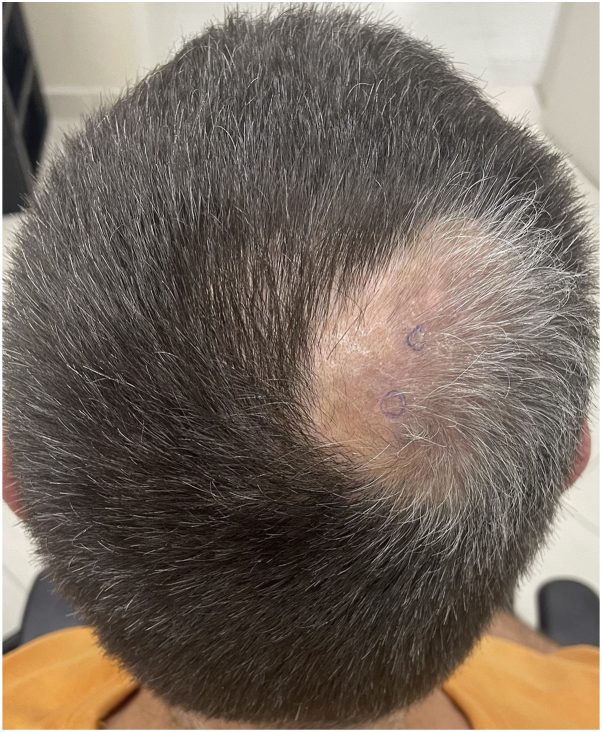 A localised patch of alopecia areata over the crown