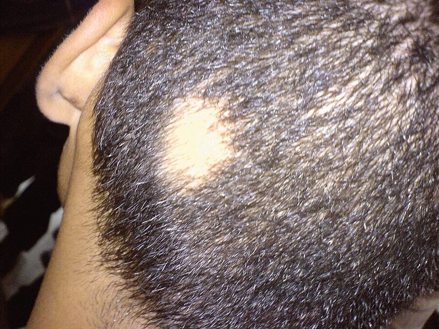 A classic round, smooth patch of alopecia areata on an otherwise normal scalp