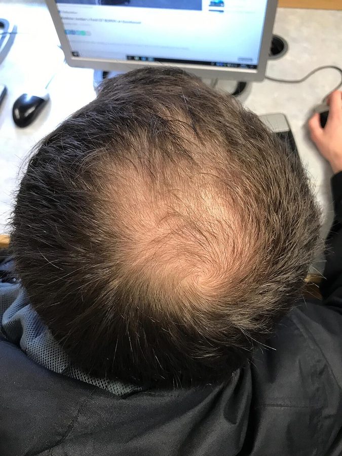 Early crown thinning seen from above
