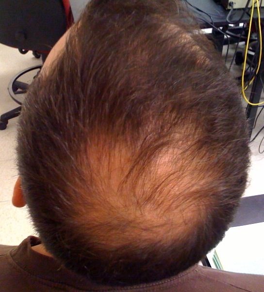 Advanced vertex hair loss