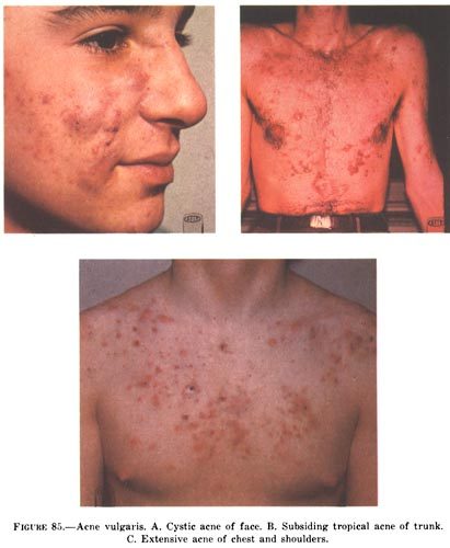 Acne involving the face, chest and back