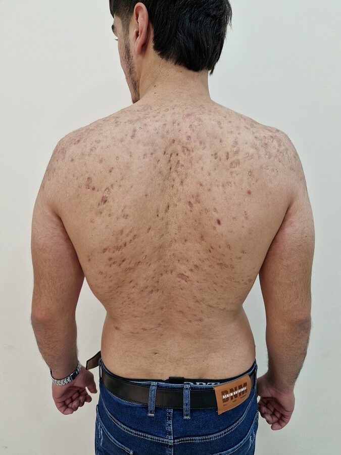 Truncal (back) acne with active lesions and post-acne marks