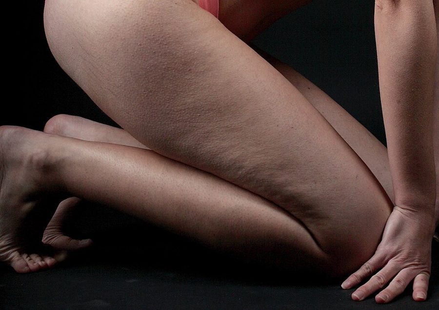 Dimpling over the thighs