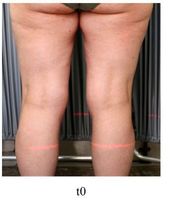 Cellulite dimpling of the posterior thighs