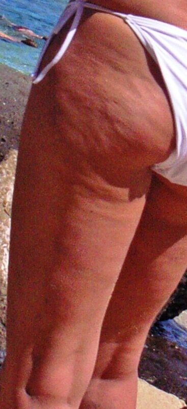The dimpled surface pattern of cellulite over the posterior thigh