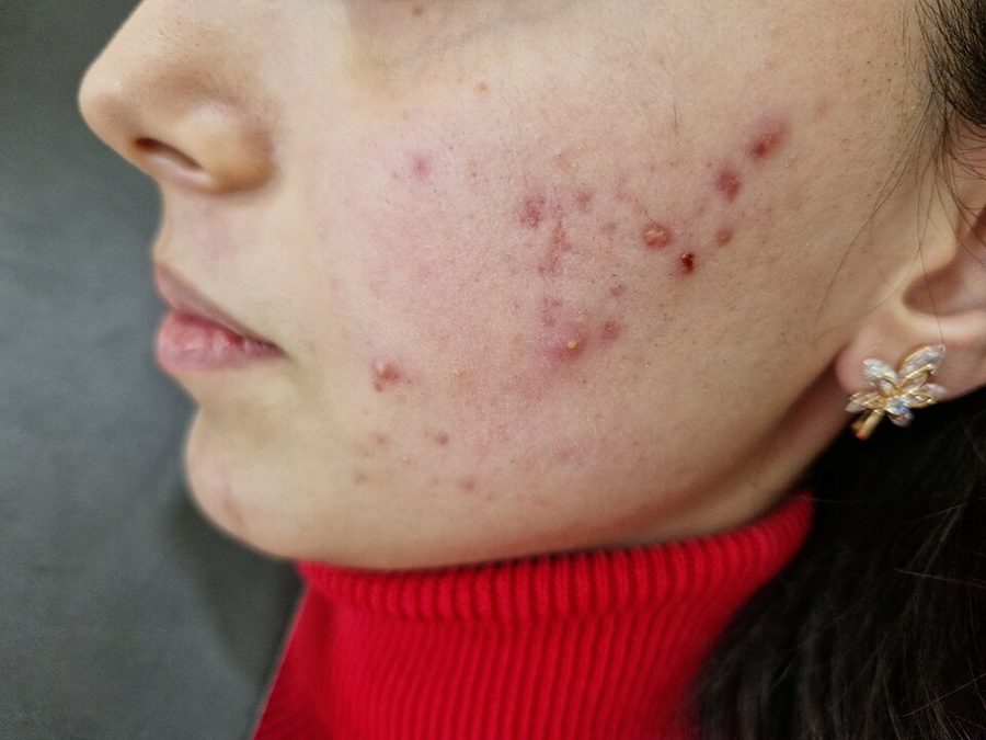 Inflamed nodules over the cheek