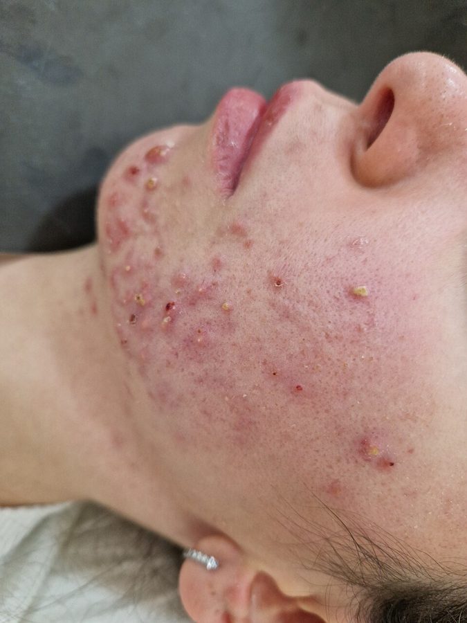 Nodules and cysts along the chin and jawline