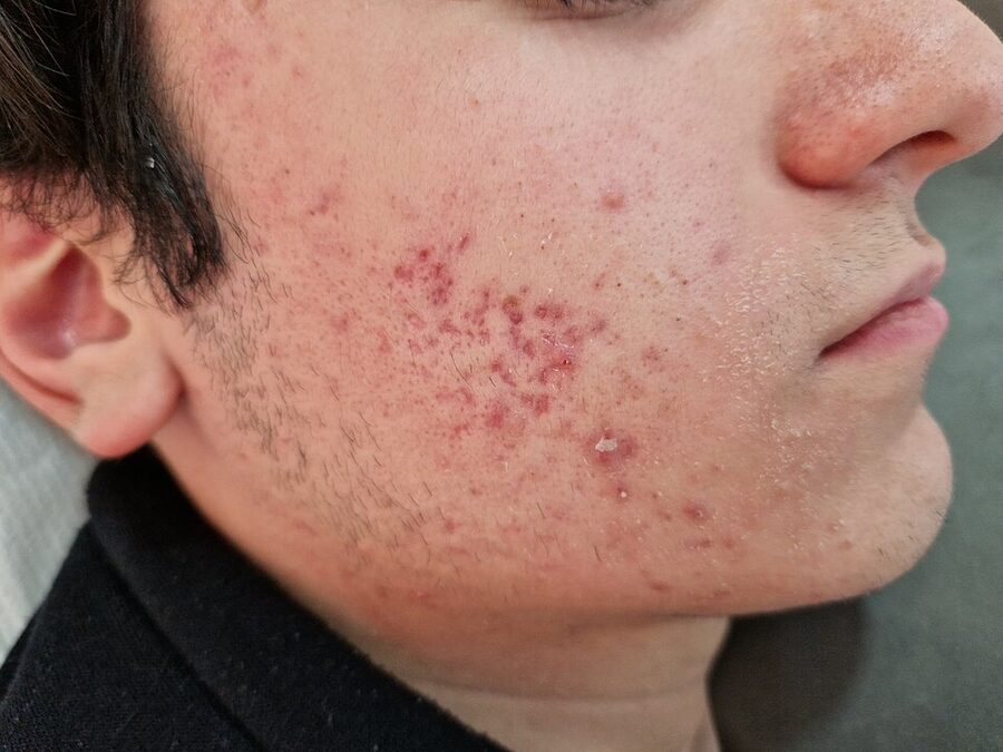 Inflammatory nodular acne of the cheek