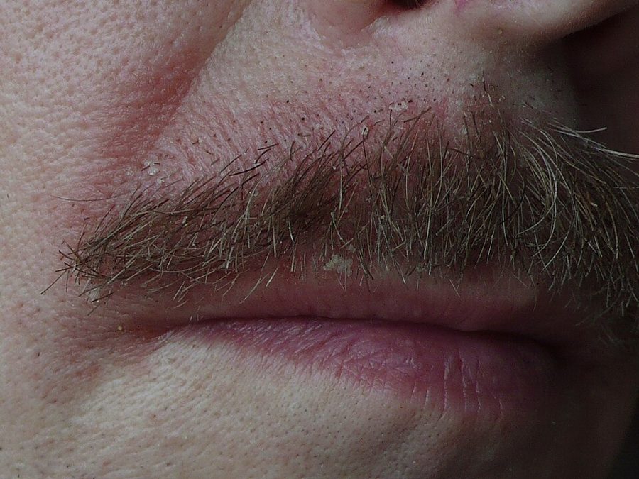 Seborrhoeic scaling in the beard and moustache area