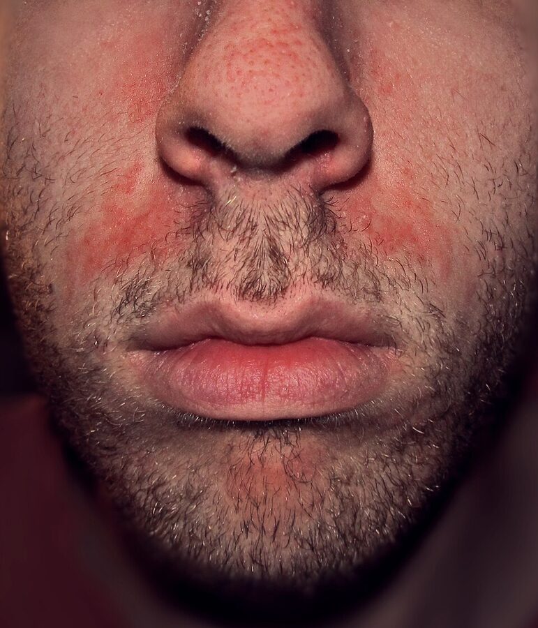 Seborrhoeic dermatitis: erythema and greasy scale in the sebaceous zones