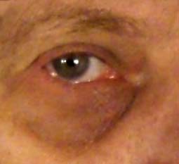 Close-up of dark circles beneath the eye