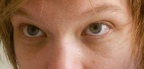 Dark circles involving both under-eye areas
