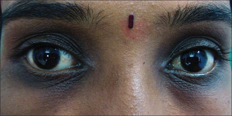 Periorbital hyperpigmentation — the pigmented type of dark eye circles