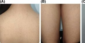 Acanthosis nigricans darkening over the upper back, thigh and arm folds