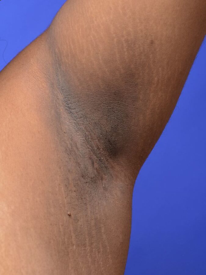 Axillary darkening with skin thickening (acanthosis nigricans pattern)