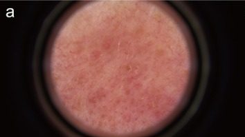 Dermoscopy of telangiectatic vessels in facial redness