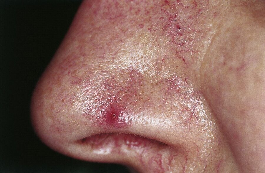 Fine dilated vessels (telangiectasia) with a central spider angioma on the nose