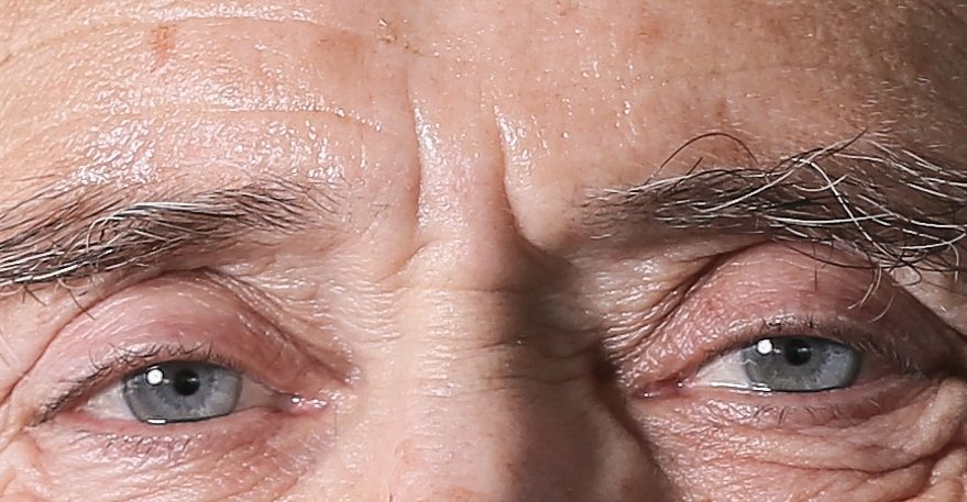 Vertical glabellar frown lines between the brows
