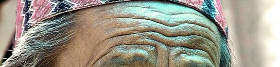 Deep static forehead lines etched into the skin at rest