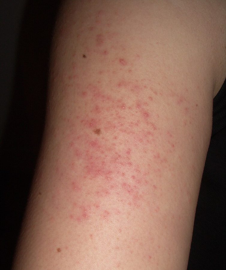 Rough follicular bumps on the upper arm