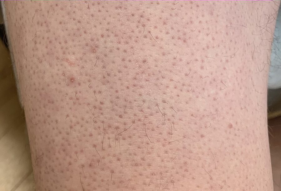 Keratosis pilaris over the leg