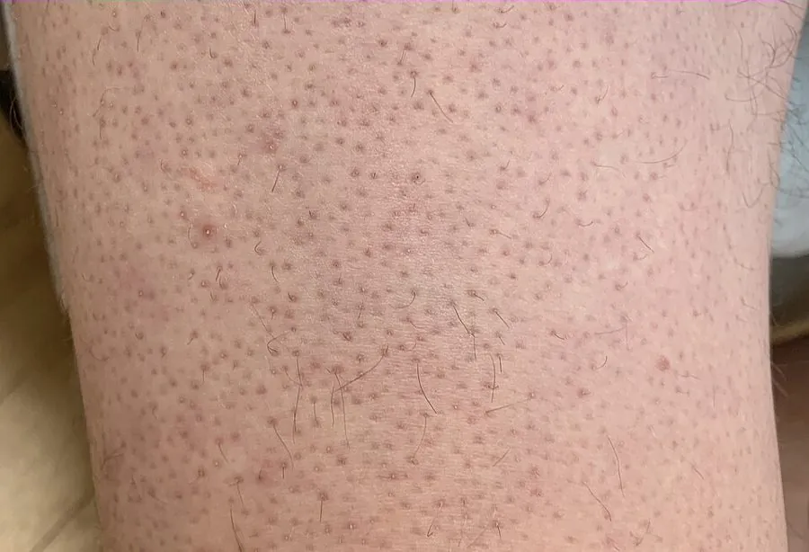 Keratosis pilaris over the leg