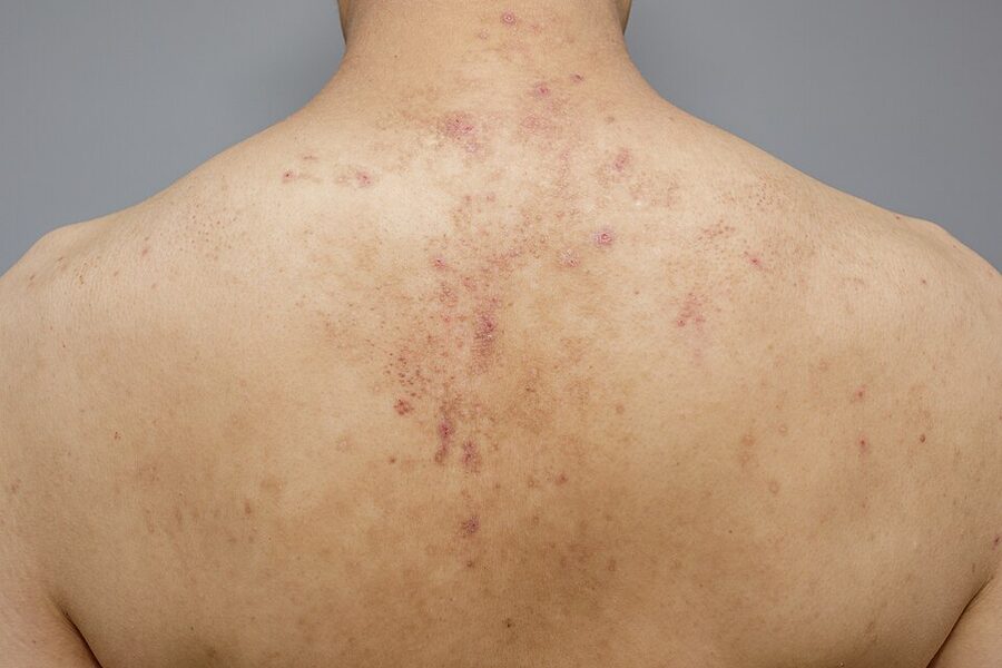 Keratosis pilaris: rough follicular papules