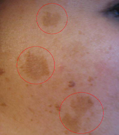 Melasma: symmetrical brown patches (circled) on sun-exposed facial skin