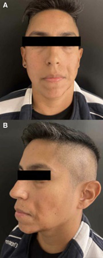 Nasolabial folds seen from the front and in profile