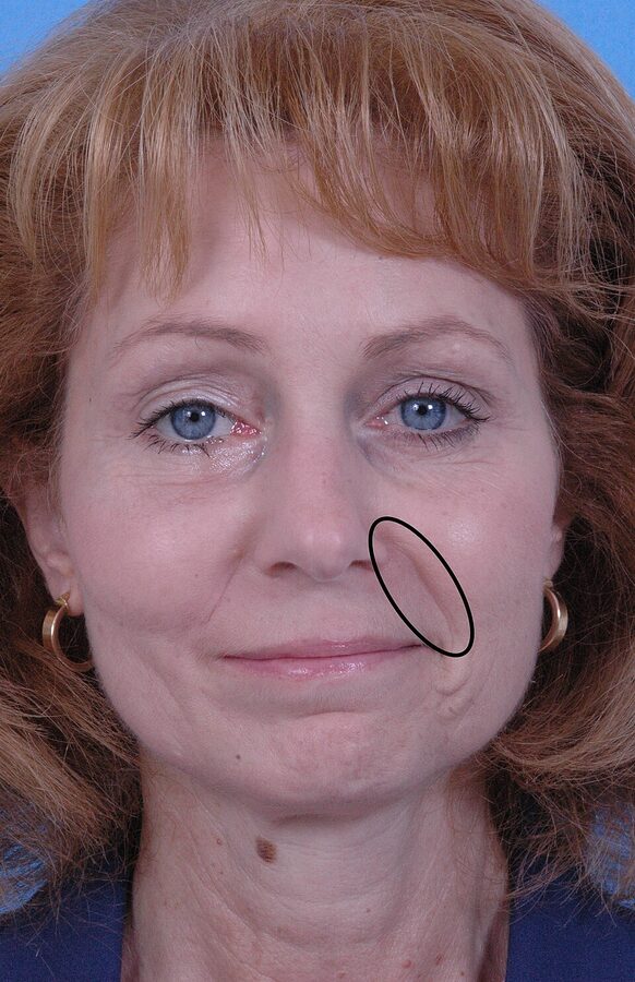 The nasolabial fold (circled) — the crease from nose to mouth corner that deepens with age