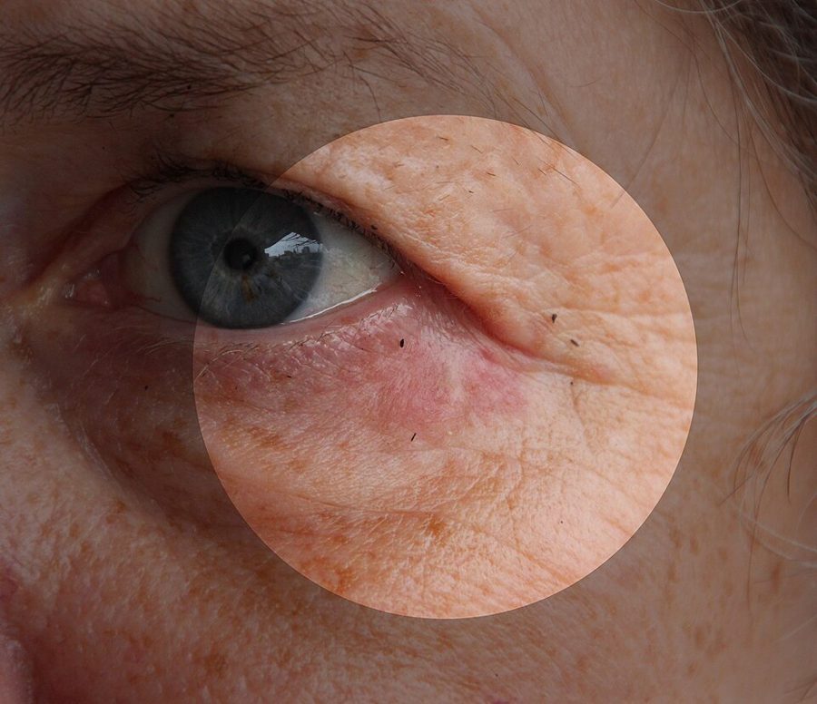 The periocular variant around the eye