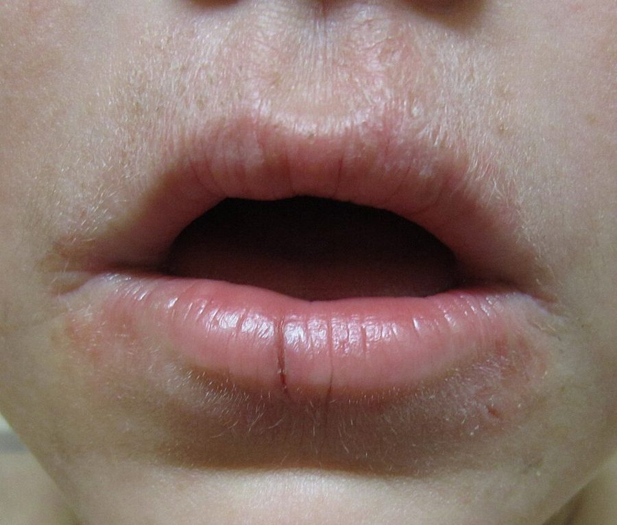 Irritant rash bordering the lips