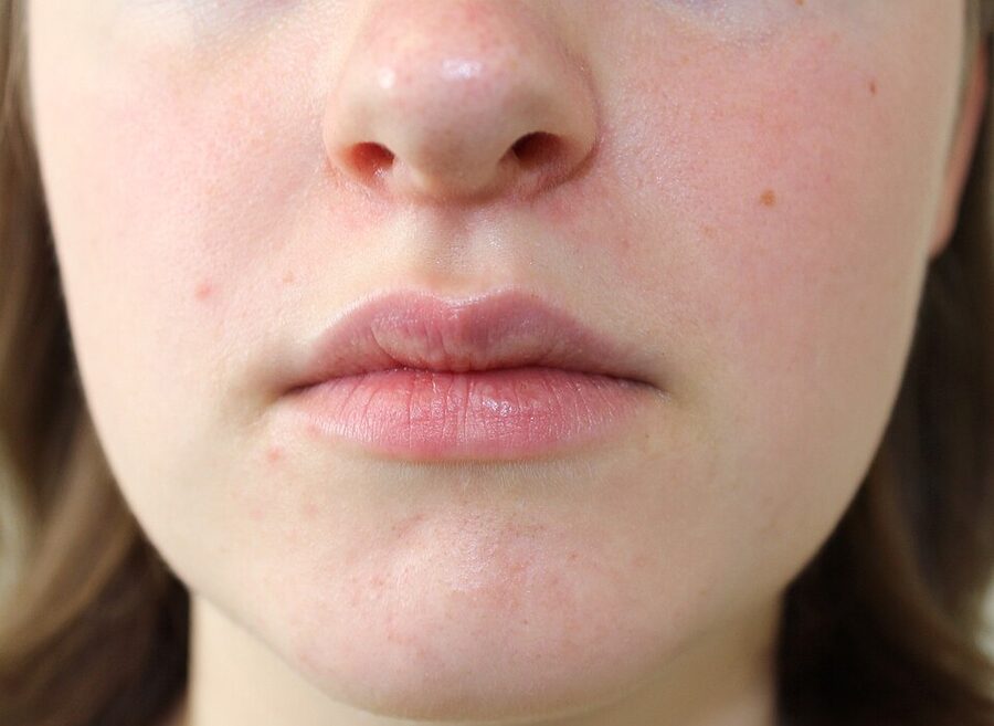Perioral dermatitis: small papules clustered around the mouth, sparing the lip margin