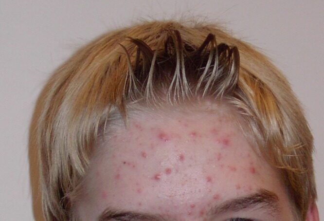 Post-inflammatory erythema: flat red marks left behind after acne settles