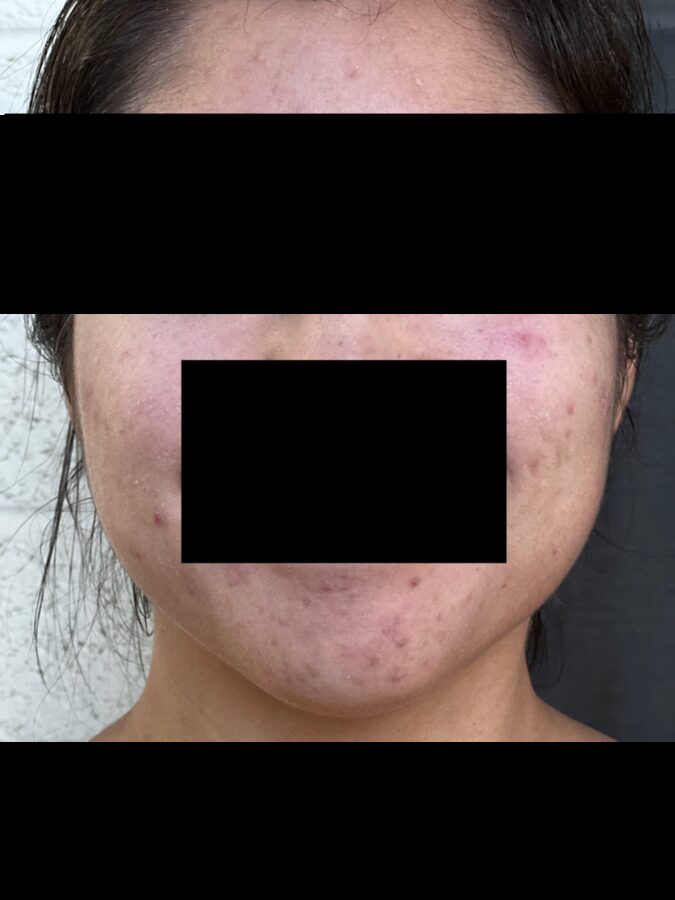 Post-inflammatory hyperpigmentation after acne (patient anonymised)