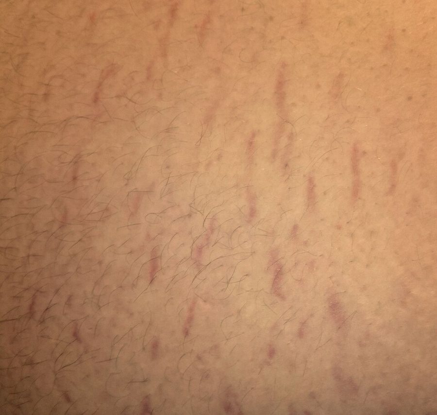 Fine striae over the abdomen