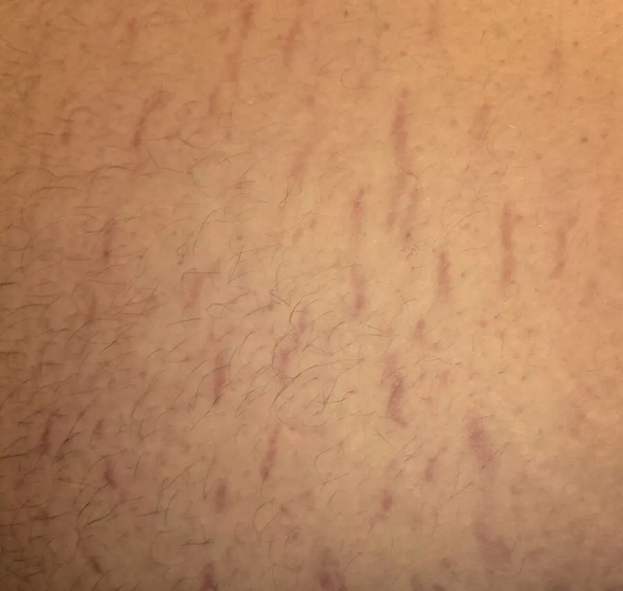 Fine striae over the abdomen