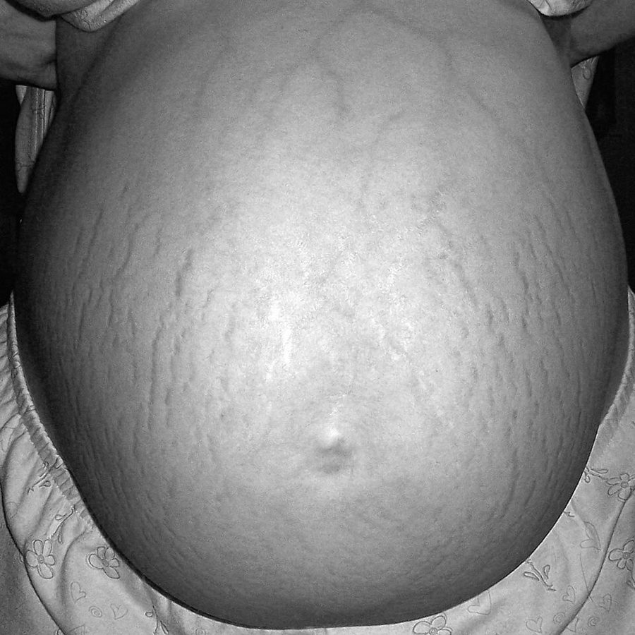 Striae gravidarum on the pregnant abdomen