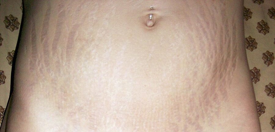 Post-pregnancy striae across the lower abdomen and hips