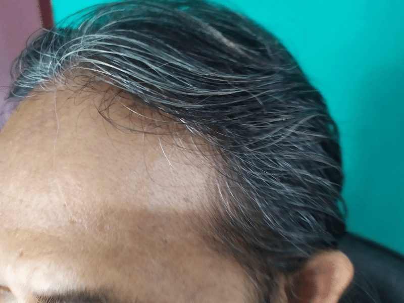 Frontal hairline recession