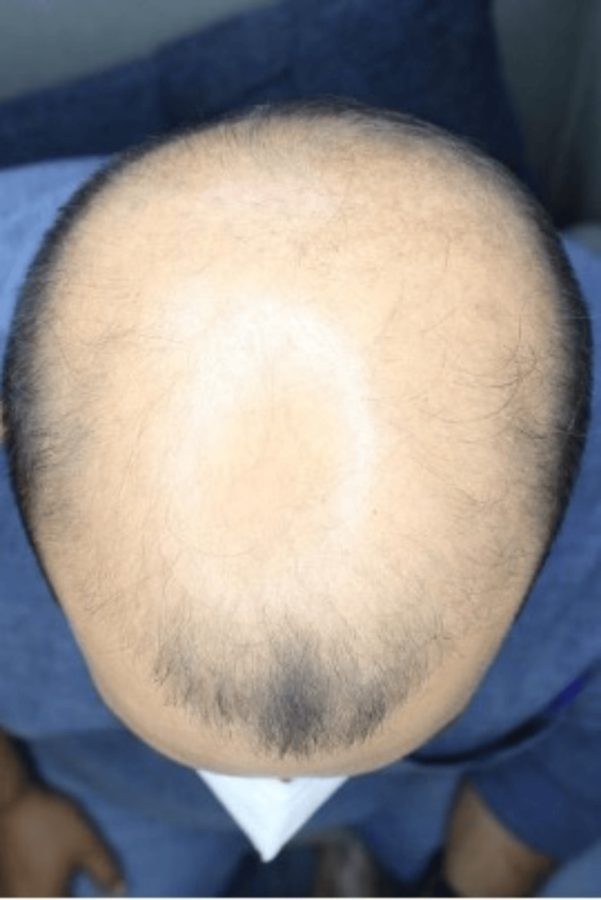 Crown and frontal thinning viewed from above