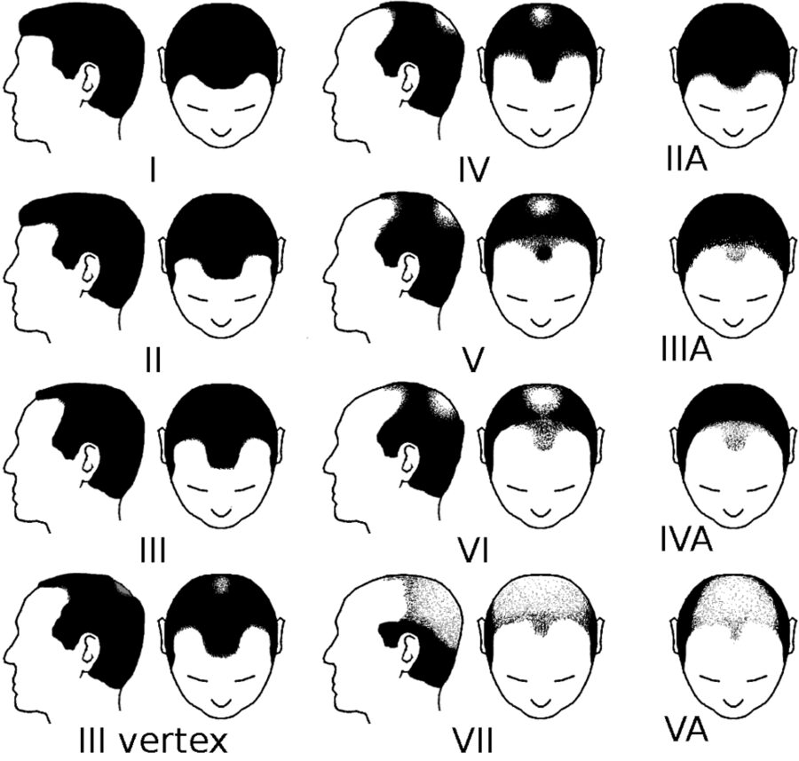 The Hamilton–Norwood scale: how a receding hairline is formally staged