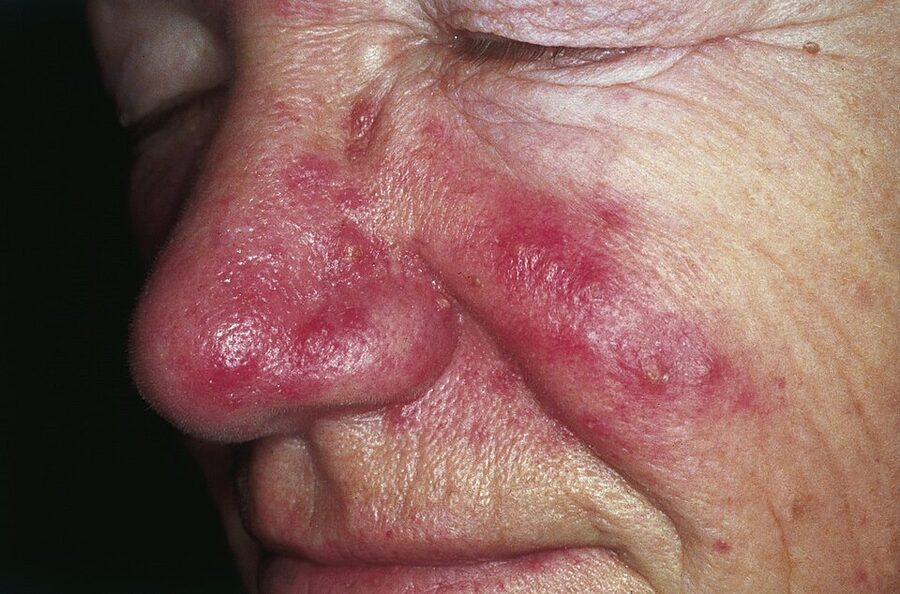 Papulopustular rosacea: persistent redness and inflammatory papules of the nose and cheek