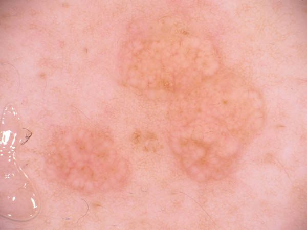 Dermoscopy view of a sebaceous hyperplasia papule