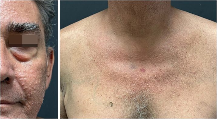 Multiple sebaceous papules on the face and chest